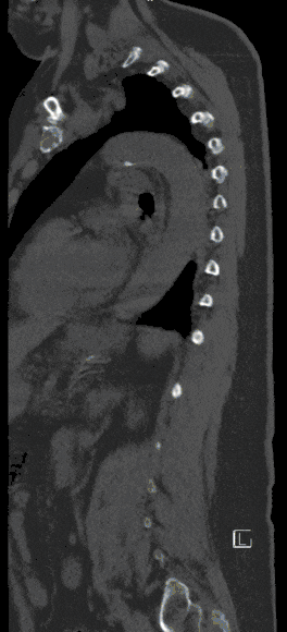 Wirbelbrueche Wirbelbrueche