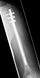 Oberarmschaftbruch2 Oberarmschaftbruch2