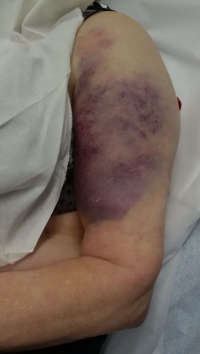 Proximaler Oberarmbruch1 Proximaler Oberarmbruch1