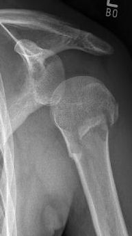 Proximaler Oberarmbruch7 Proximaler Oberarmbruch7