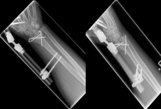 Handgelenk 5 Handgelenk 5