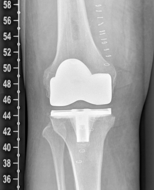 Ro_Bilder_postop_3 Röntgenbild nach OP von vorn