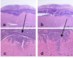 Mouse_brain_infiltration_by_malignant_meningioma_cells