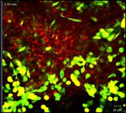 OHC infiltration by GFP-tagged malignant meningioma cells